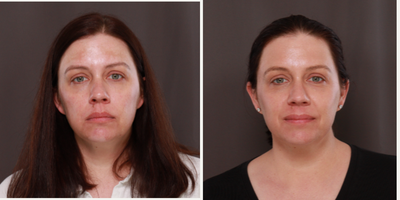 35-44 year old woman treated with Halo Laser, Moxi - Halo and Moxi StaX treatment to improve texture and melasma