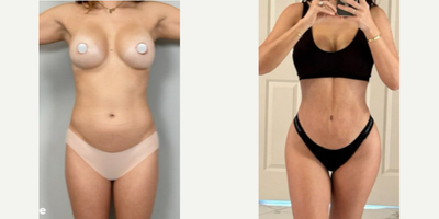 Woman treated with Brazilian Butt Lift - Woman treated with Brazilian Butt Lift using vaser technology