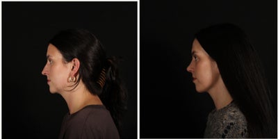 25-34 year old woman treated with Rhinoplasty, Neck Lift, Buccal Fat Removal - 6 weeks after rhinoplasty, deep neck lift, renuvion skin tightening, and buccal fat removal! Our patient has been healing beautifully and we are loving the (early) result! Thanks to her for allowing us to share. Combing procedures is hugely helpful to achieving a more profound, intricate, but natural result. Here we refined the neck and the nose concurrently.