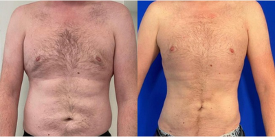 Man treated with Breast Fat Transfer - Patient had Liposuction with another surgeon previously. He was unhappy with the uneven and lumpy result. We carried out Liposuction to the Abdomen and flanks with Fat transfer to the upper pole of the chest to create a more even and symmetrical result. Patient is now 6 weeks post-op, he will still have some swelling.
