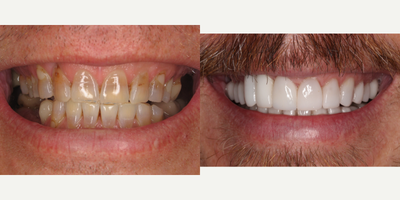 45-54 year old man treated with Dental Implants - This patient had severe wear and internal staining due to tetracycline medication as a child. This patient's right lateral incisor was unable to be restored with a crown or veneer alone, so it is replaced with a dental implant and crown to complete this beautiful smile makeover.