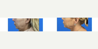 55-64 year old woman treated with CoolMini, CoolSculpting - 55-64 year old woman treated with CoolMini, CoolSculpting