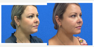 35-44 year old woman treated with CoolMini, CoolSculpting, Cryolipolysis - 35-44 year old woman treated with CoolSculpting