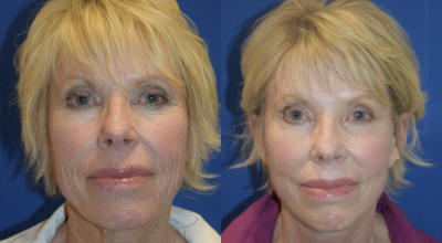 65-74 year old woman treated with Renuvion - Face treated with Renuvion