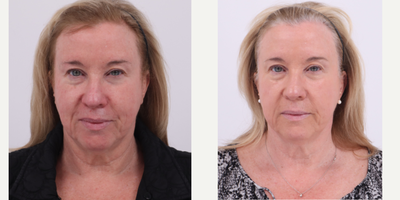 55-64 year old woman treated with BroadBand Light (BBL) - before and after 2 BBL treatments to address rosacea and uneven skin tone.