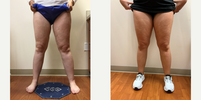 35-44 year old woman treated with EVLT, Sclerotherapy - Patient had an EVLT and 2 sclerotherapy treatments performed.