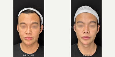 25-34 year old man treated with Skin Tightening - Endolift for Facial Slimming