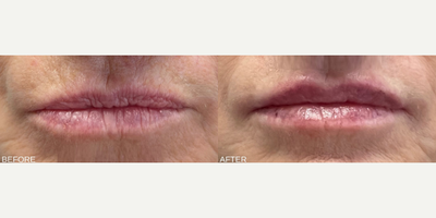 Woman treated with Restylane Kysse - Woman treated with Restylane Kysse