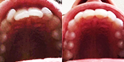 Straighten your teeth without braces - Photo provided courtesy of SmileDirectClub.