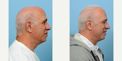 65-74 year old man treated with Hand Rejuvenation - Performing a hair transplant on someone with Norwood 7 level hair loss can be difficult, but not impossible in the hands of a skilled surgeon such as Dr. Wise. This 68-year-old patient had an FUE hair transplant with 2,400 grafts transplanted in zones 1 through 3 to combat balding. Six months post-procedure, he is so happy with the outcome, he is opting for a secondary transplant to fill in the crown as well. More growth is expected from the original procedure by the one year mark.