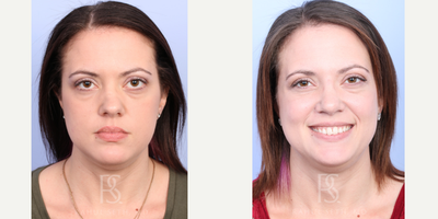 25-34 year old woman treated with Rhinoplasty, Facial Reconstructive Surgery, Septoplasty - Major nose reconstruction with rib cartilage/bone to restore the nose to a natural appearance and ability to breathe.