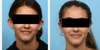 17 or under year old woman treated with Ear Surgery - This 14-year-old patient turned to Dr. Wise because she was self-conscious about her ear size, and the way they stuck out. Dr. Wise performed an otoplasty to reposition the ears, resulting in a vastly improved appearance. The patient's after photos were taken 2 months post-op.