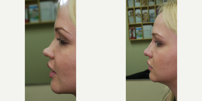 25-34 year old woman treated with Juvederm - young woman injected with Juvederm for non-surgical nose correction to
address depressed profile