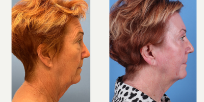 70 year old woman treated with Phenol Peel - Dr. Sam Sukkar performed a Phenol Peel on this 70 year old patient. Post-Op photos taken at just 3 months after procedure.