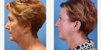 70 year old woman treated with Phenol Peel - Dr. Sam Sukkar performed a Phenol Peel on this 70 year old patient. Post-Op photos taken at just 3 months after procedure.