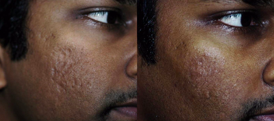 25-34 year old man treated with Acne Scars Treatment - One Treatment with subcision by Dr Sadove