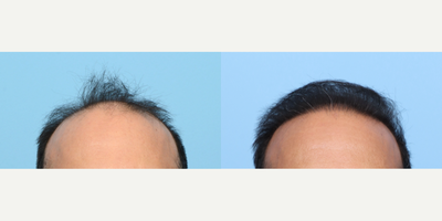 45-54 year old man treated with FUE Hair Transplant, Hair Transplant, Hair Loss Treatment, PRP for Hair Loss - This patient began losing hair in his twenties and at age 46 was ready to go through with a permanent solution. To restore lost hair and add density, Dr. Wise performed an FUE hair transplant, where he transplanted 3,600 grafts to zones 1,2, and 3 of his scalp. During the procedure, he also performed one session of PRP therapy to stimulate the hair follicles and improve the thickness and quality of existing hair.