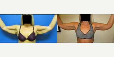 35-44 year old woman treated with Arm Lift - She lost weight and wanted the loose skin on her arms removed. Postoperative photos were taken 1 year after surgery.