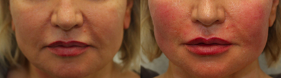 Thread lift for cheeks and jawline - This woman underwent thread lift with PDO barbed threads followed by Restylane Lyft to improve her jawline, cheeks, and nasolabial folds.