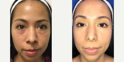 35-44 year old woman treated with Restylane - Restylane Defyne injection around the mouth and under the eyes to treat lines and eye bags.