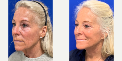 55-64 year old woman treated with Facelift, Neck Lift, Eyelid Surgery, Facial Fat Transfer, TCA Peel - 61 year old 3 months  facelift, necklift, upper bleph, lower bleph, fat transfer, tca peel with Dr. Madnani