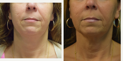 55-64 year old woman treated with Ultherapy - 55-64 year old woman treated with Ultherapy of the lower face. The after photo was taken just 3 months later with full results expected at 6 months.