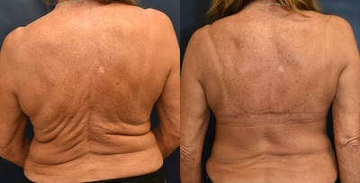 55-64 year old woman treated with Body Lift - This patient has scoliosis which accentuated the excess skin on her back. The doctorperformed a backlift to remove the excess skin and restore her confidence.