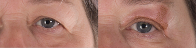 55-64 year old woman treated with Laser Treatment - Plasma Fibroblast (PlasmaLift) Upper Eyelid Lift
