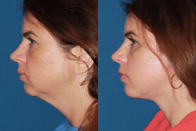 35-44 year old woman treated with Mini Lift - This patient was concerned the loss of smooth jawline contour and neck skin laxity. Facial rejuvenation procedure included a mini facelift and neck lift. Youthful facial contour was acheved and the defenition of the neck was restored.