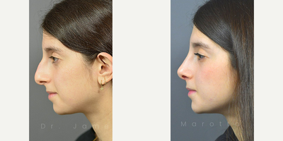 Rhinoplasty - This patient who just 6 months ago was wondering the same thing.