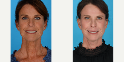 Woman treated with Laser Resurfacing - Woman treated with Facelift, Neck Lift, Brow Lift, Full Face Laser (Erbium Sciton Laser), and Facial Fat Transfer, shown 2 months post op.