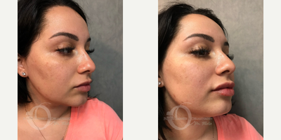 25-34 year old woman treated with Lip Augmentation - lip augmentation