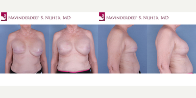 65-74 year old woman treated with Breast Reconstruction - 69 year old female treated with Breast Reconstruction.