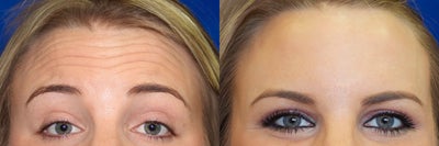 Woman treated with Injectable Fillers - Woman treated with Injectable Fillers. Received a Botox treatment to prevent the formation of lines to the forehead, crows feet and glabella.