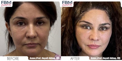 45-54 year old woman treated with Deep Plane Facelift, Canthoplasty, Cheek Lift, Chin Liposuction, Neck Lift, Buccal Fat Removal - 45-54 year old woman treated with Deep Plane Facelift, Canthoplasty, Cheek Lift, Chin Liposuction, Neck Lift, Buccal Fat Removal, Lip Lift
