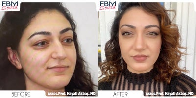 25-34 year old woman treated with Rhinoplasty - 25-34 year old woman treated with Rhinoplasty