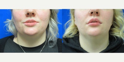 Juvderm, Lip Fillers - Patient wanted to have upper lip to have more fullness.  Dr. Eric Schaffer injected one syringe of Juvederm.