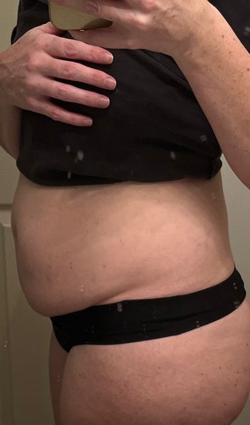 Tummy Tuck after Weight Loss - Halifax, NS