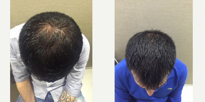 25-34 year old man treated with PRP for Hair Loss - Results of 5 session of PRP treatment or 13 months with 1000mg Biotin per day.