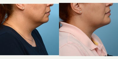 35-44 year old woman treated with Chin Surgery - A double chin and inadequate projection were the reasons this 37-year-old patient sought out Dr. Wise. Seven weeks after her combination chin implant/ submental liposuction surgery, she absolutely loves the definition and contour of her new jawline!