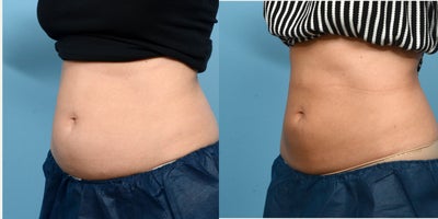 25-34 year old woman treated with Cryolipolysis - 1 session of CoolSculpting for the abdomen.