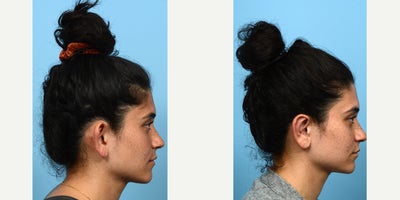 18-24 year old woman treated with Earfold, Ear Surgery - Having big ears is a common concern with a simple solution -- otoplasty, or ear surgery. Often times, overly projected ears are misconstrued as being disproportionately sized for a person's head. In truth, the issue lies in the way the ear is shaped, and by creating a new helical fold or adjusting the placement of the conchal bowl, the ears can be perceived to be much smaller. This was the case for this 24-year-old patient, who is thrilled with the outcome of her ear surgery with Dr. Wise.