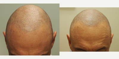 45-54 year old man treated with Scalp Micropigmentation - 45-54 year old man treated with Scalp Micropigmentation