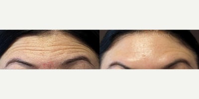 35-44 year old woman treated with Botox, Dysport - Treatment of lines and wrinkles in forehead, glabella & frown lines (with Botox, Jeuveau, Dysport, Daxxify or Xeomin)