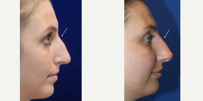 25-34 year old woman treated with RHA Collection Fillers for Liquid Rhinoplasty - 26 year old woman treated with RHA Collection Fillers for Liquid Rhinoplasty