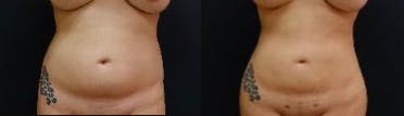 25-34 year old woman treated with Brazilian Butt Lift - The patient underwent a Brazilian Butt Lift (butt augmentation with liposculpting and fat transfer). The combination of the liposculpting and the fat transfer enhance her butt and overall figure. She has a snatched waist and hourglass figure after her Brazilian Butt Lift.