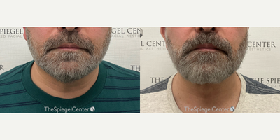 55-64 year old man treated with Nonsurgical Neck Lift - NeckTite