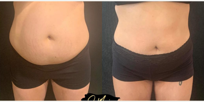 25-34 year old woman treated with Evolve - Evolve Body Contouring