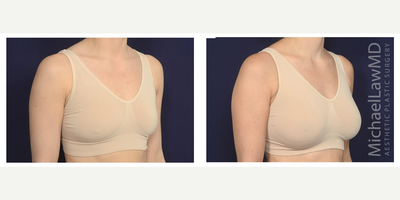 25-34 year old woman treated with Mentor Breast Implants - Breast augmentation. Follow-up photos taken 3 months after the procedure.