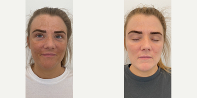 25-34 year old woman treated with Obagi Nu-Derm - Treatment options for pigmentation include laser, dermapen, prp, medical skin peels and take home prescription skin care from Z.O Zein Obagi medical which contains hydroquinone. As an essential part of our treatment programs are we will also recommend you maintenance to control your pigmentation once the treatments have been completed. We also recommend wearing a SPF 50 with UVB and UVA as a crucial step in your home routine when treating pigmentation as exposure to the sun results in pigment re-occuring once treated.